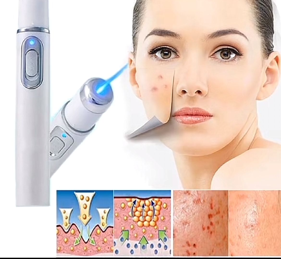 Lápiz Láser Terapia de Luz Azul Elimina Acné, Manchas , Cicatrices y Rejuvenece Tu Piel