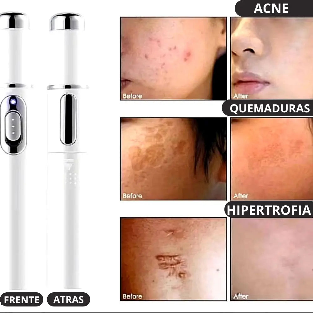 Lápiz Láser Terapia de Luz Azul Elimina Acné, Manchas , Cicatrices y Rejuvenece Tu Piel