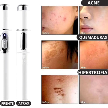 Lápiz Láser Terapia de Luz Azul Elimina Acné, Manchas , Cicatrices y Rejuvenece Tu Piel